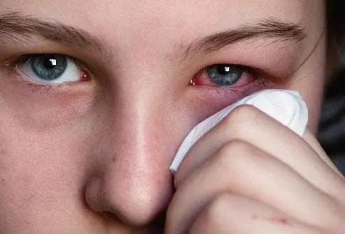 conjuntivitis
